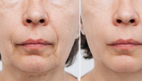 رفع خط خنده